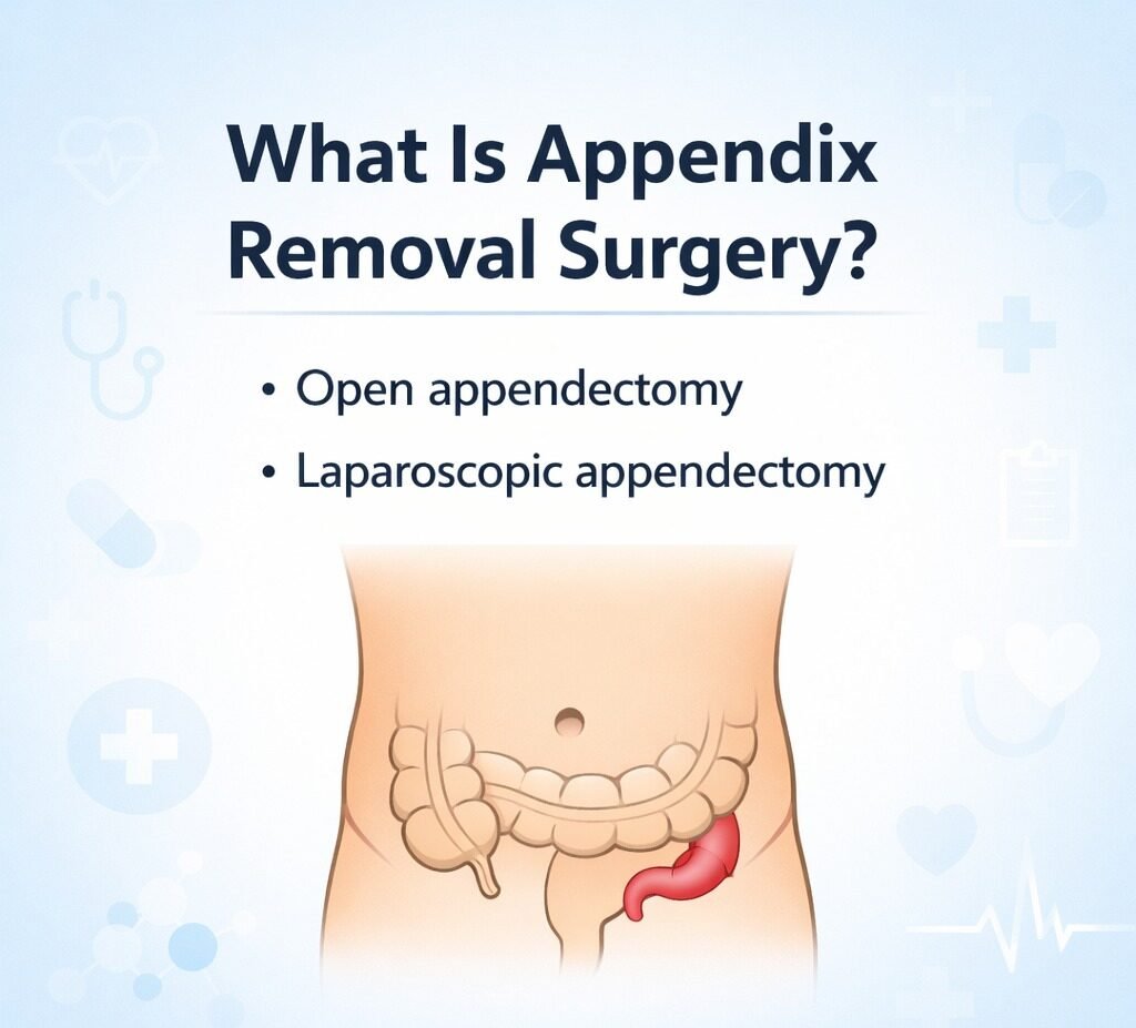 What Is Appendix Removal Surgery?