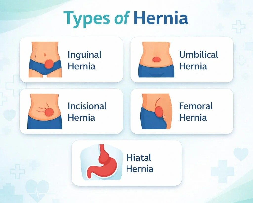 types of hernia